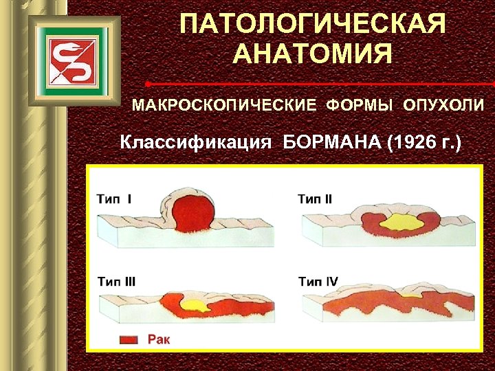 ПАТОЛОГИЧЕСКАЯ АНАТОМИЯ МАКРОСКОПИЧЕСКИЕ ФОРМЫ ОПУХОЛИ Классификация БОРМАНА (1926 г. ) 