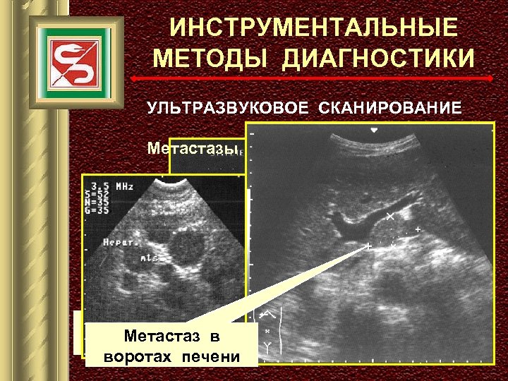 ИНСТРУМЕНТАЛЬНЫЕ МЕТОДЫ ДИАГНОСТИКИ УЛЬТРАЗВУКОВОЕ СКАНИРОВАНИЕ Метастазы в паренхиме печени ПЕРВИЧНАЯ ОПУХОЛЬ Метастаз в (эндофитный