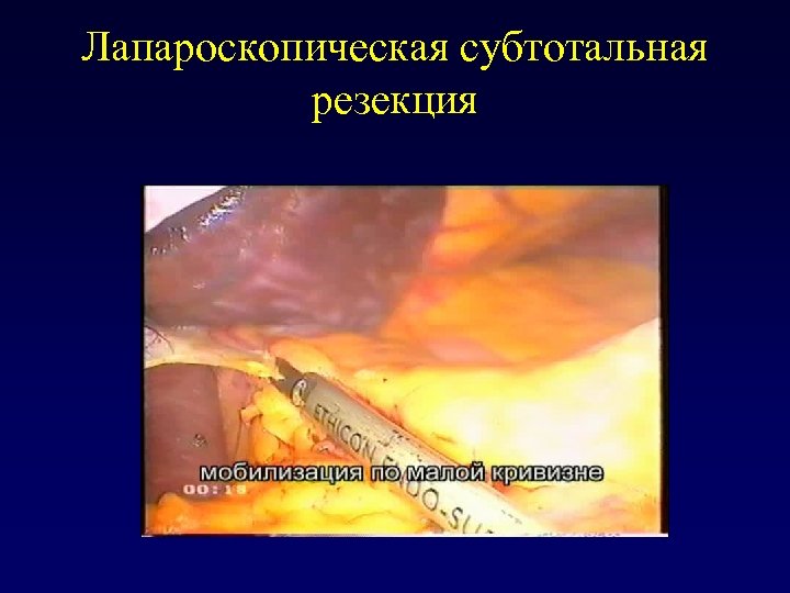 Лапароскопическая субтотальная резекция 