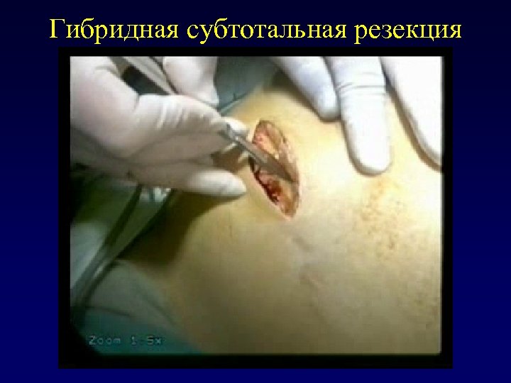 Гибридная субтотальная резекция 
