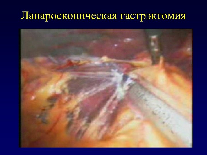 Лапароскопическая гастрэктомия 