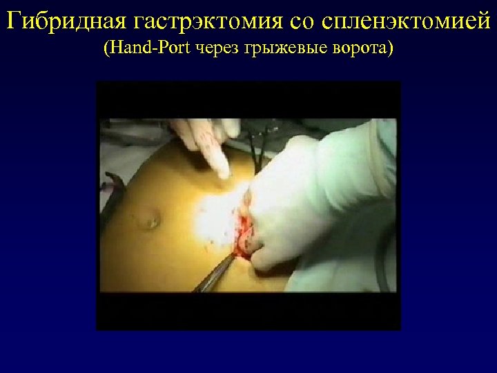 Гибридная гастрэктомия со спленэктомией (Hand-Port через грыжевые ворота) 
