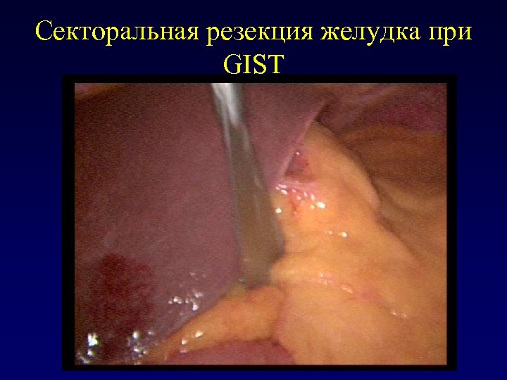 Секторальная резекция желудка при GIST 