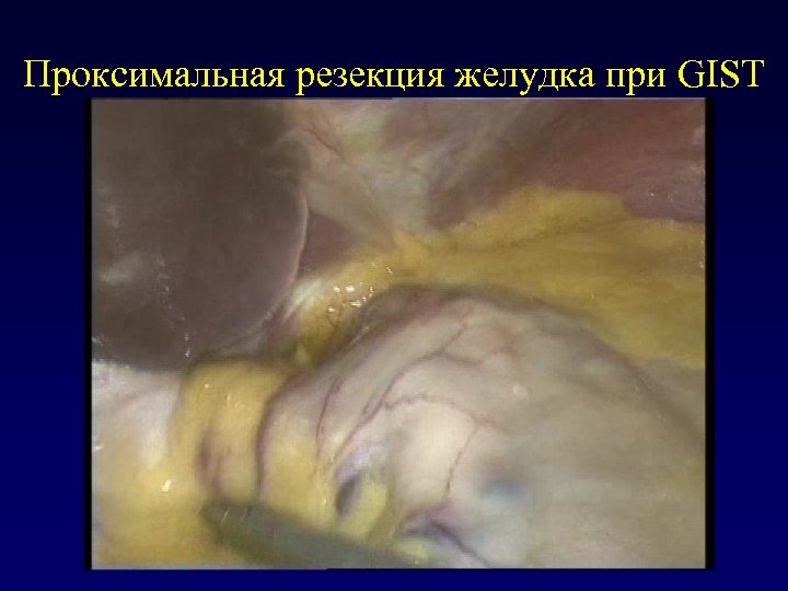 Проксимальная резекция желудка при GIST 