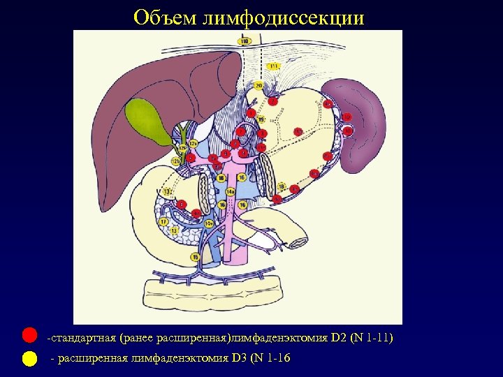 Лимфаденэктомия