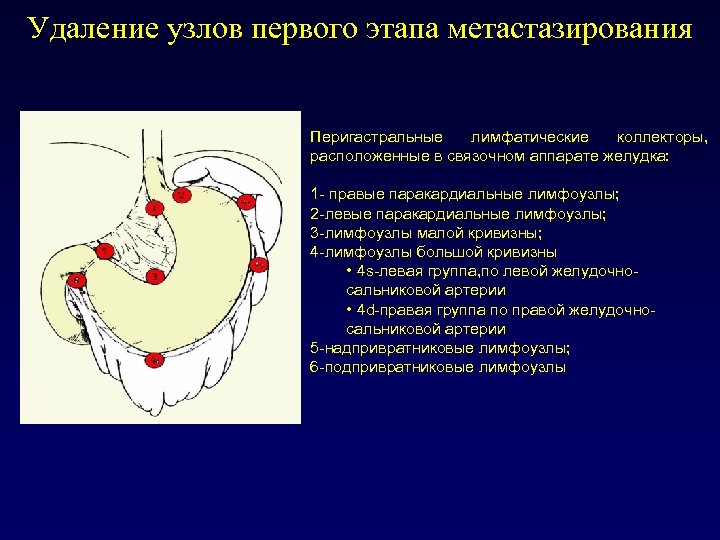 Удаленный узел. Паракардиальные лимфатические узлы. Перигастральные лимфатические узлы. Лимфоузлы по малой кривизне желудка. Лимфоузлы малой кривизны желудка.