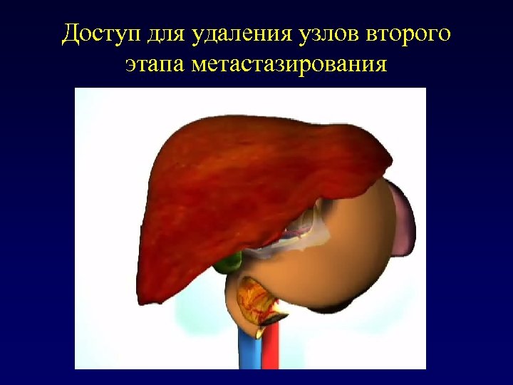 Доступ для удаления узлов второго этапа метастазирования 