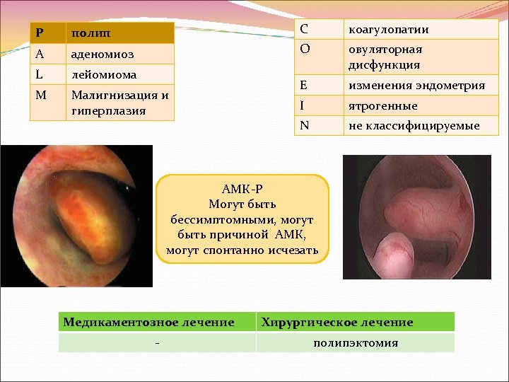 P полип C коагулопатии A аденомиоз O L лейомиома овуляторная дисфункция M Малигнизация и