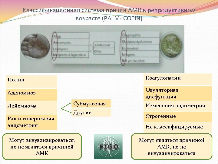 Классификационная система причин АМК в репродуктивном возрасте (PALM- COEIN) Полип Коагулопатии Аденомиоз Овуляторная дисфункция
