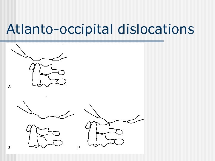 Atlanto-occipital dislocations 