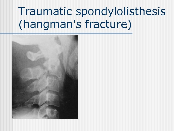 Traumatic spondylolisthesis (hangman's fracture) 