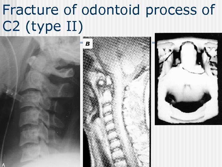 Fracture of odontoid process of C 2 (type II) 