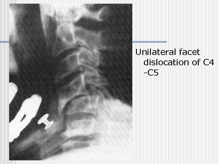 Unilateral facet dislocation of C 4 -C 5 