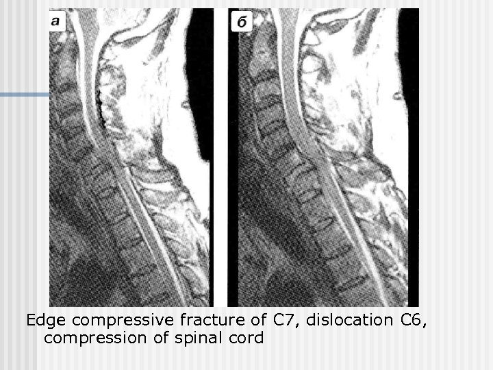 Edge compressive fracture of С 7, dislocation С 6, compression of spinal cord 