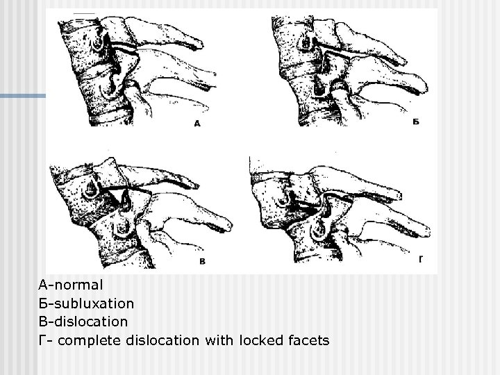 А-normal Б-subluxation В-dislocation Г- complete dislocation with locked facets 