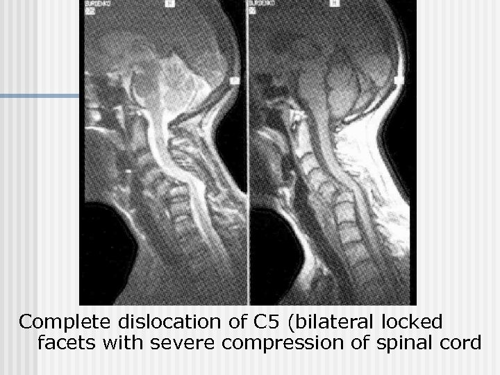 Complete dislocation of C 5 (bilateral locked facets with severe compression of spinal cord