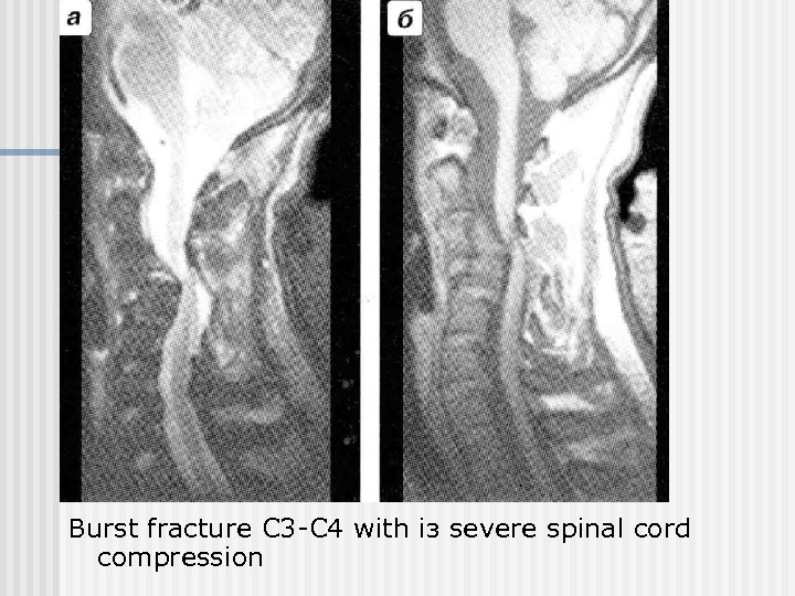 Burst fracture С 3 -С 4 with із severe spinal cord compression 