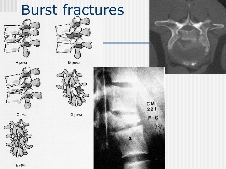 Burst fractures 