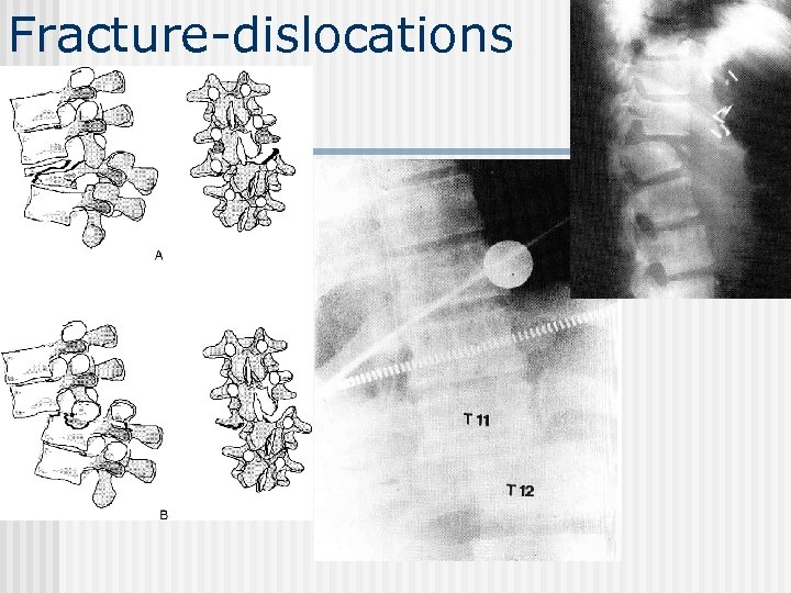 Fracture-dislocations 