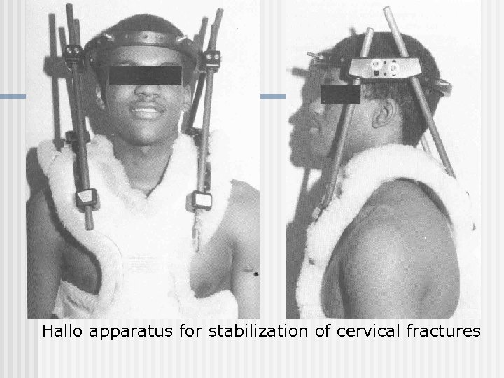 Hallo apparatus for stabilization of cervical fractures 