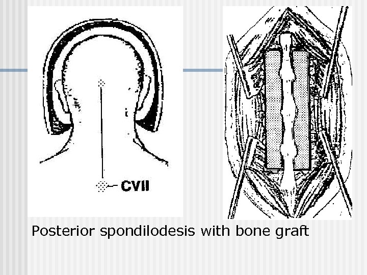 Posterior spondilodesis with bone graft 