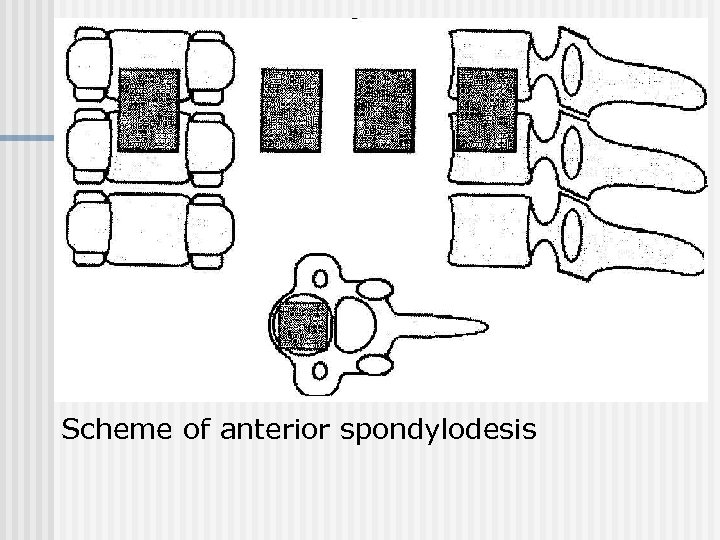 Scheme of anterior spondylodesis 