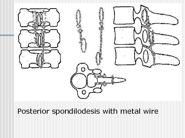 Posterior spondilodesis with metal wire 
