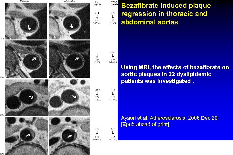 Bezafibrate induced plaque regression in thoracic and abdominal aortas Using MRI, the effects of