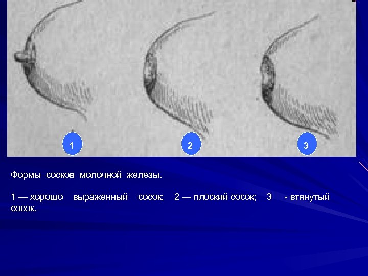 1 2 3 Формы сосков молочной железы. 1 — хорошо сосок. выраженный сосок; 2