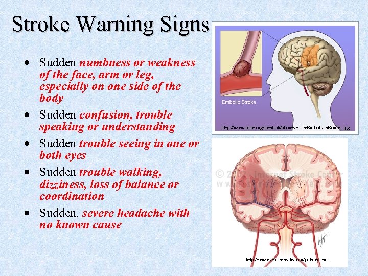 Stroke Warning Signs · Sudden numbness or weakness of the face, arm or leg,