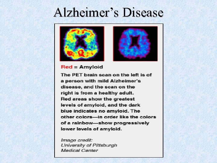 Alzheimer’s Disease 