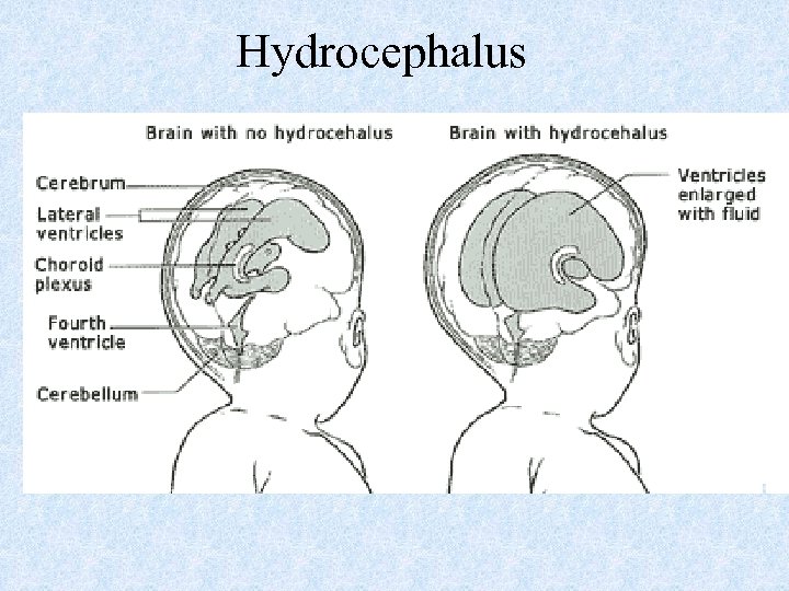 Hydrocephalus 