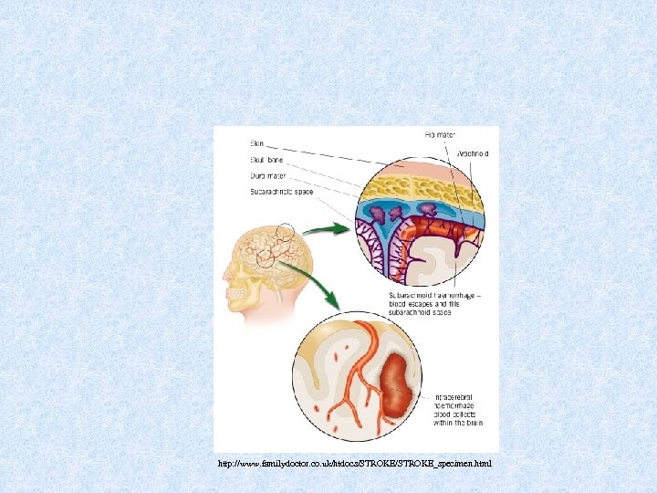 http: //www. familydoctor. co. uk/htdocs/STROKE_specimen. html 