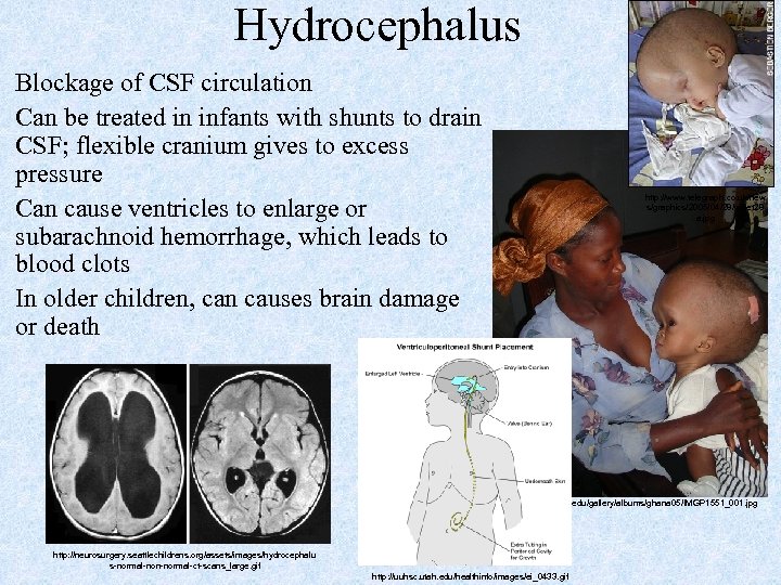 Hydrocephalus Blockage of CSF circulation Can be treated in infants with shunts to drain