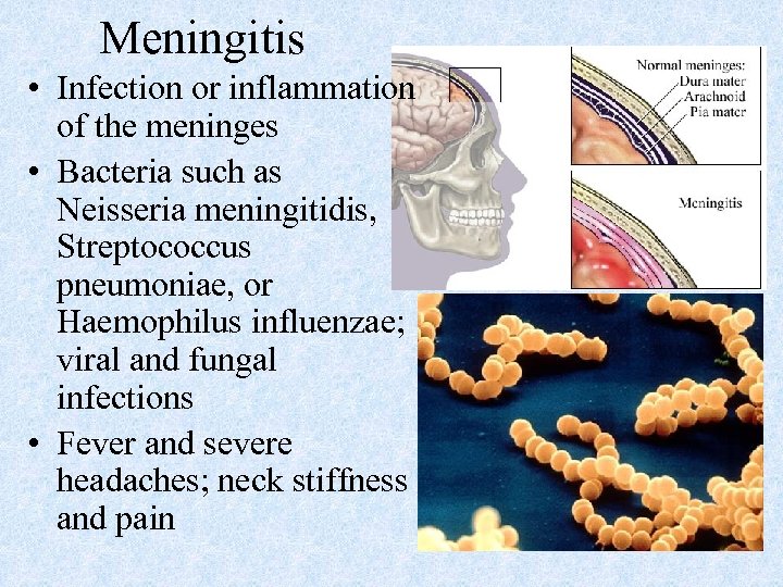 Meningitis • Infection or inflammation of the meninges • Bacteria such as Neisseria meningitidis,