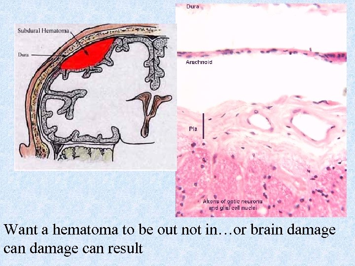 Want a hematoma to be out not in…or brain damage can result 