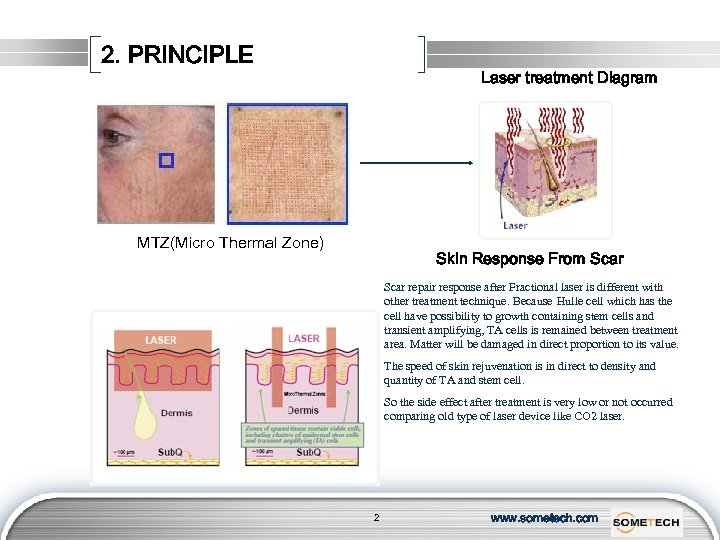 2. PRINCIPLE Laser treatment Diagram MTZ(Micro Thermal Zone) Skin Response From Scar repair response