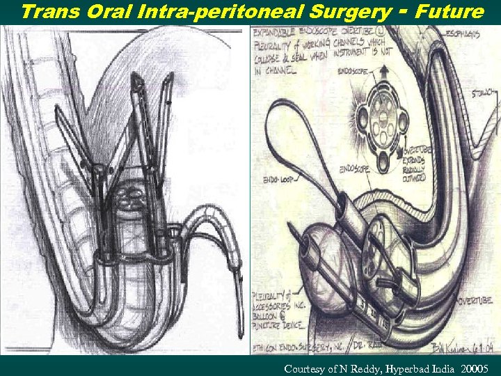Trans Oral Intra-peritoneal Surgery - Future Courtesy of N Reddy, Hyperbad India 20005 