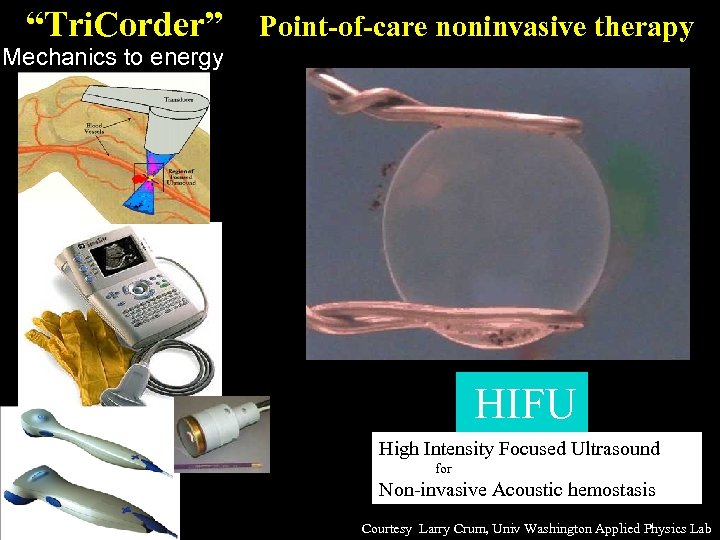 “Tri. Corder” Point-of-care noninvasive therapy Mechanics to energy HIFU High Intensity Focused Ultrasound for
