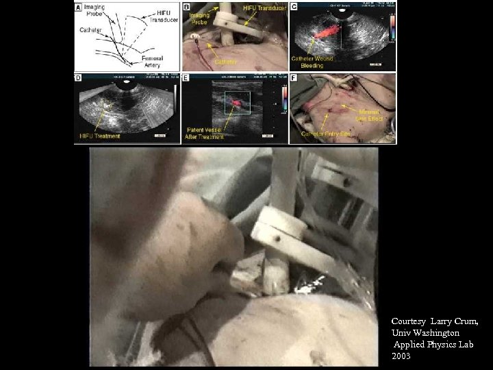 Courtesy Larry Crum, Univ Washington Applied Physics Lab 2003 