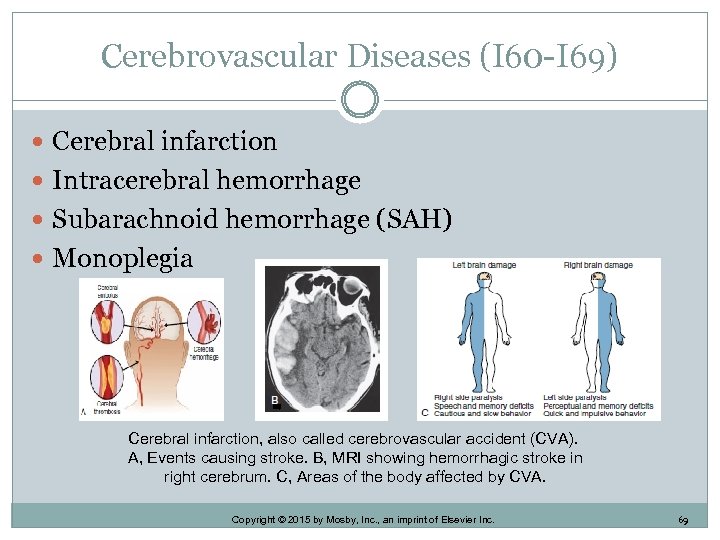 Cerebrovascular Diseases (I 60 -I 69) Cerebral infarction Intracerebral hemorrhage Subarachnoid hemorrhage (SAH) Monoplegia