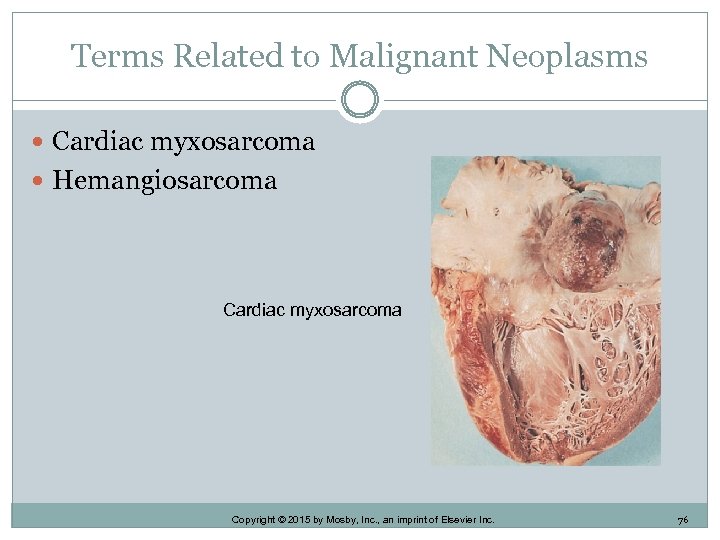 Terms Related to Malignant Neoplasms Cardiac myxosarcoma Hemangiosarcoma Cardiac myxosarcoma Copyright © 2015 by