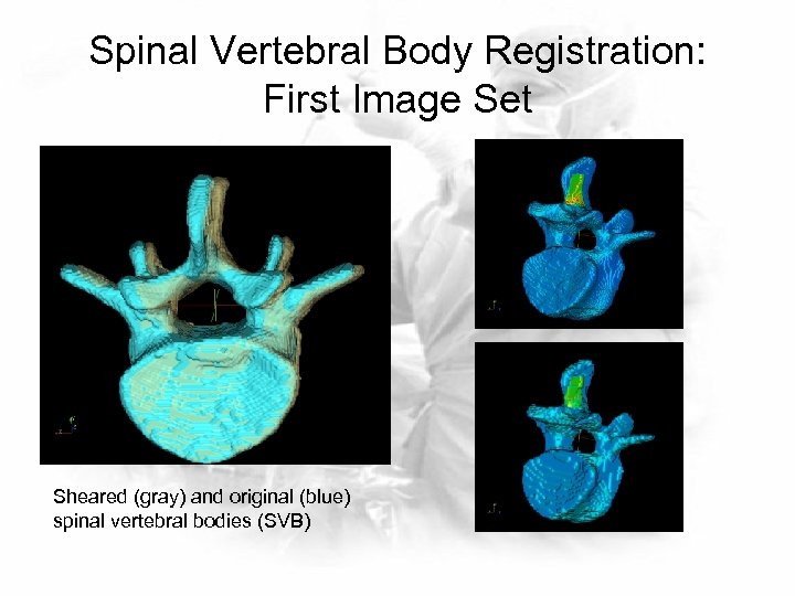 Spinal Vertebral Body Registration: First Image Set Sheared (gray) and original (blue) spinal vertebral