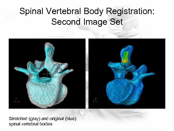 Spinal Vertebral Body Registration: Second Image Set Stretched (gray) and original (blue) spinal vertebral