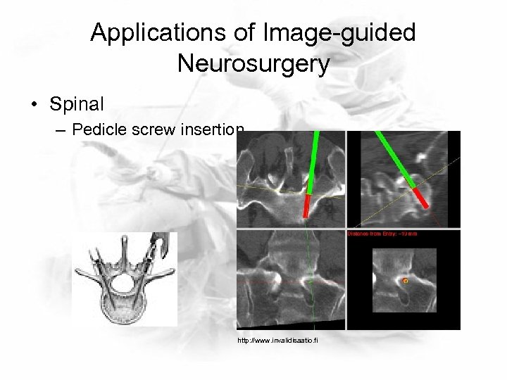 Applications of Image-guided Neurosurgery • Spinal – Pedicle screw insertion http: //www. invalidisaatio. fi