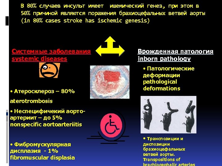 В 80% случаев инсульт имеет ишемический генез, при этом в 50% причиной являются поражения