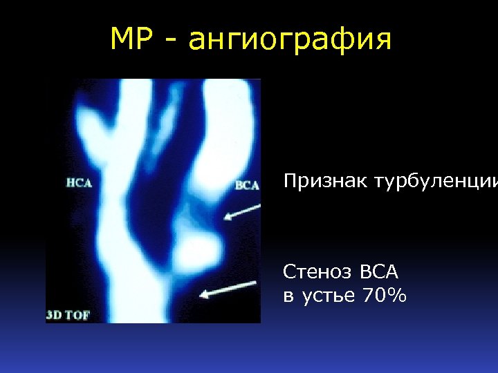 МР - ангиография Признак турбуленции Стеноз ВСА в устье 70% 