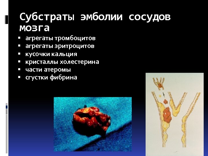Субстраты эмболии сосудов мозга агрегаты тромбоцитов агрегаты эритроцитов кусочки кальция кристаллы холестерина части атеромы