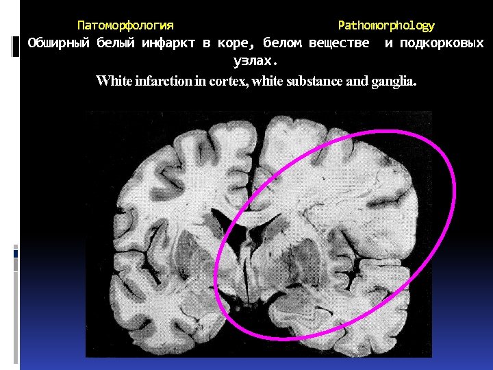 Патоморфология Pathomorphology Обширный белый инфаркт в коре, белом веществе и подкорковых узлах. White infarction
