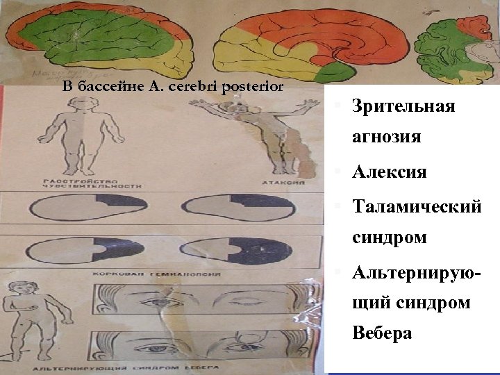В бассейне А. cerebri posterior Зрительная агнозия Алексия Таламический синдром Альтернирую- щий синдром Вебера